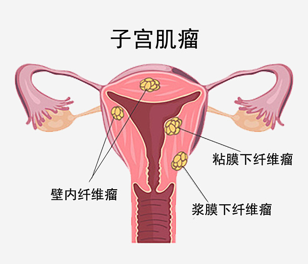 子宫肌瘤 ：女性健康的隐形守护者