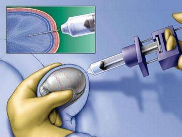 解读睾丸穿刺术