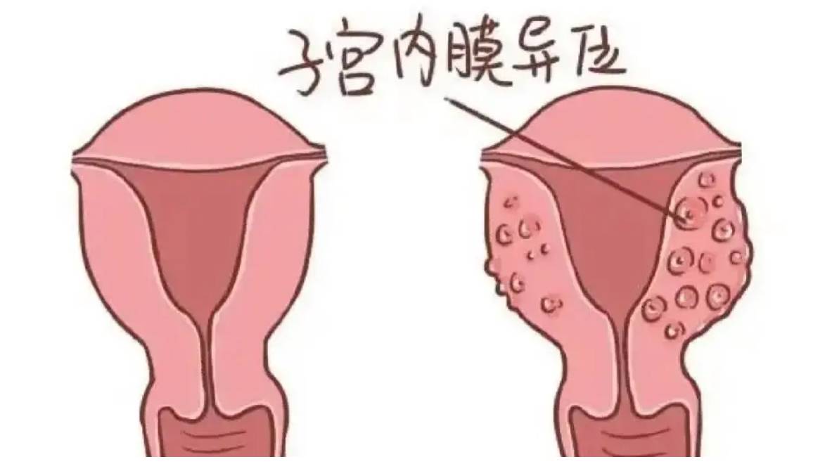 不孕之子宫内膜异位症
