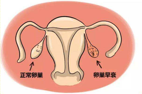卵巢早衰，这些高危因素你有吗？