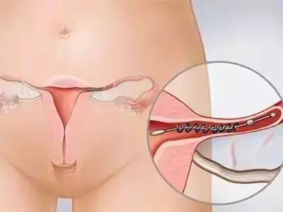 输卵管堵塞了该如何检查？